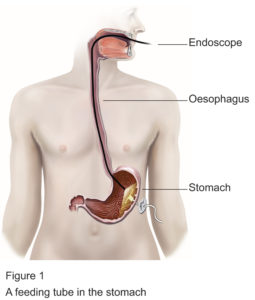 A feeding tube into the stomach diagram