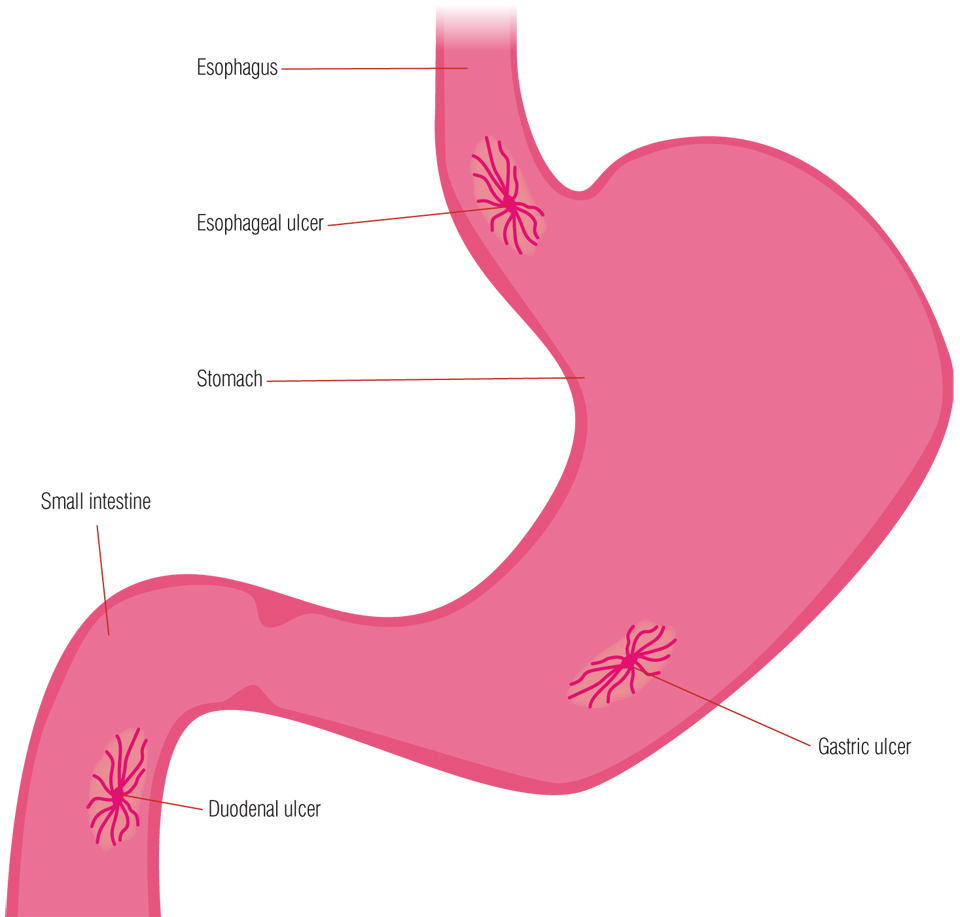 helicobacter pylori problems it can cause diagram