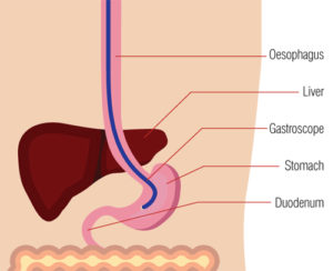 Indigestion endoscopy diagram