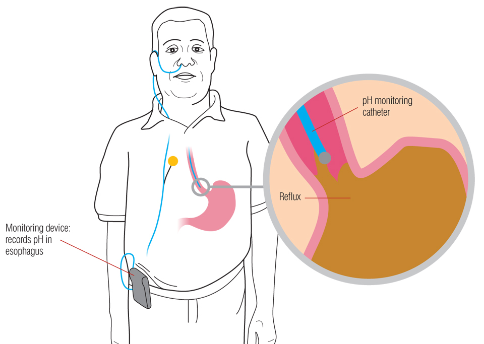 reflux heartburn monitoring devices records ph in esophagus diagram