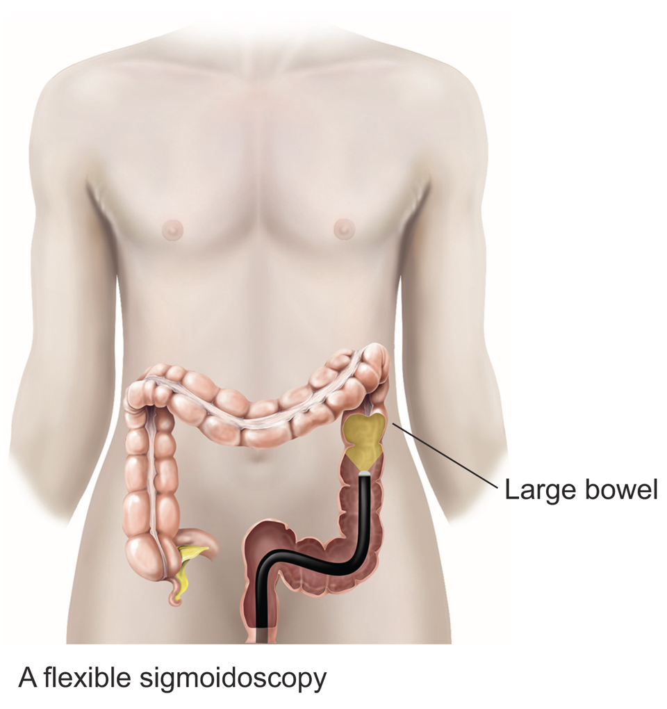Flexible Sigmoidoscopy procedure diagram